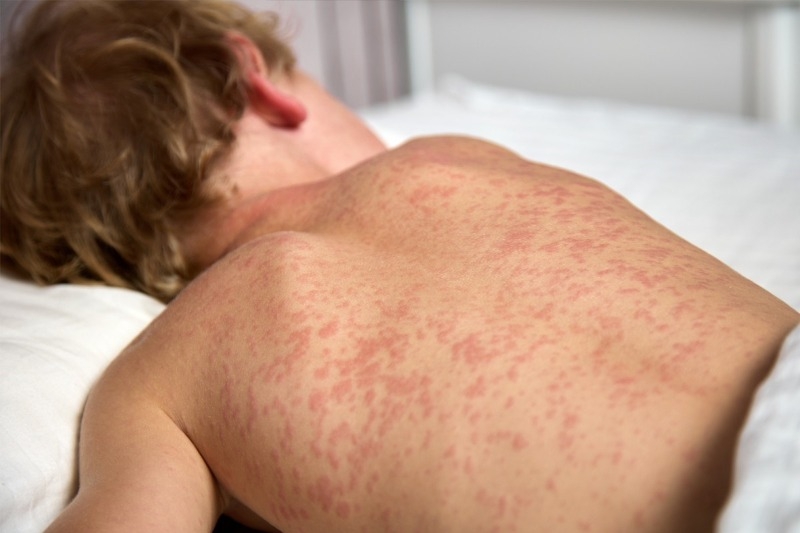Young Child laying on his tummy showing his back with a red rash all over